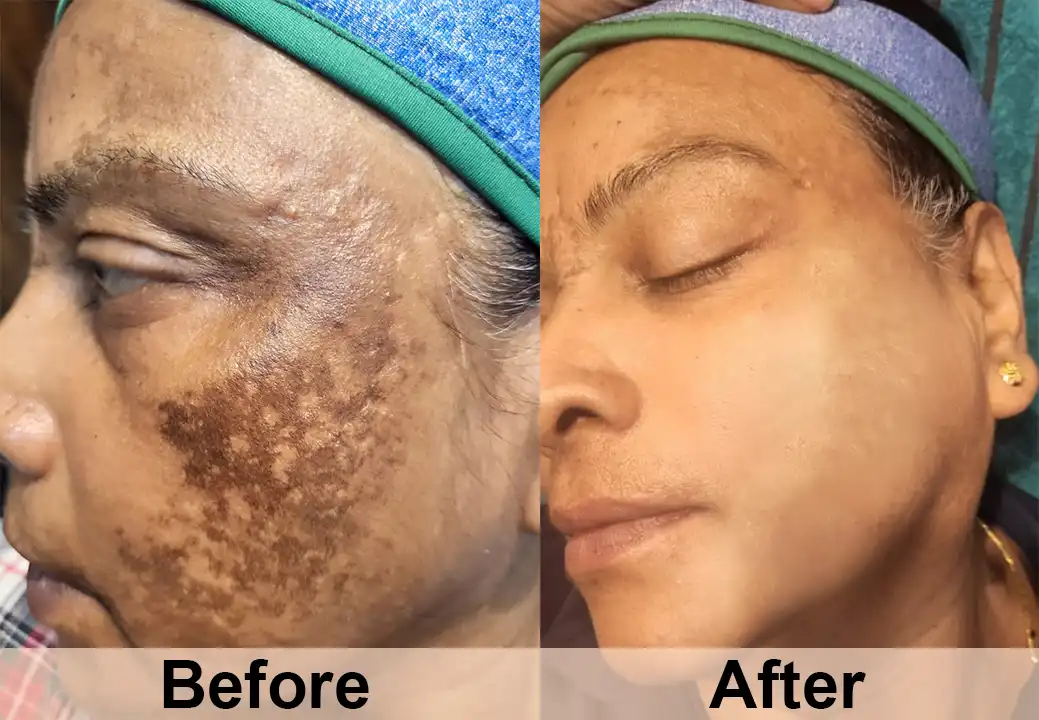 pigmentation treatment During Treatment Laser Session Result