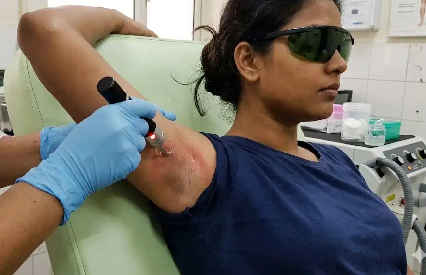 laser hair reduction in noida Glo Glamm Dr Sonali